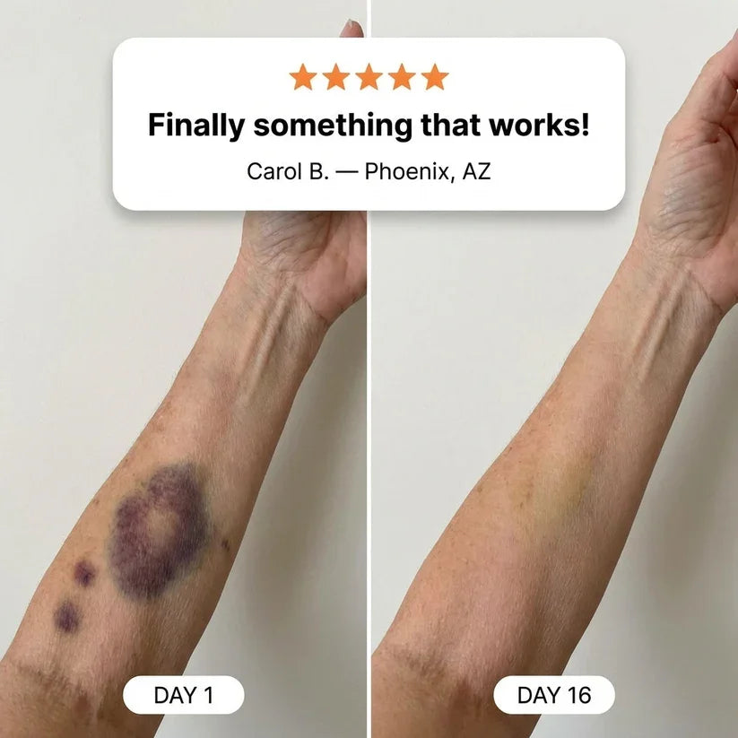 š„300K+ SOLDš-TopSpireĀ® Bruise Repair & Skin-Strengthening Cream