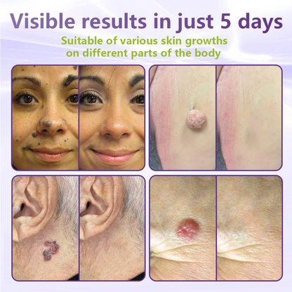 💗YOOPULSE® SOLUBLE MICRONEEDLE BOTANICAL SKIN TAG REMOVAL PATCH-ZDJ