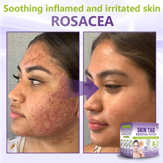 💗YOOPULSE® SOLUBLE MICRONEEDLE BOTANICAL SKIN TAG REMOVAL PATCH-ZDJ