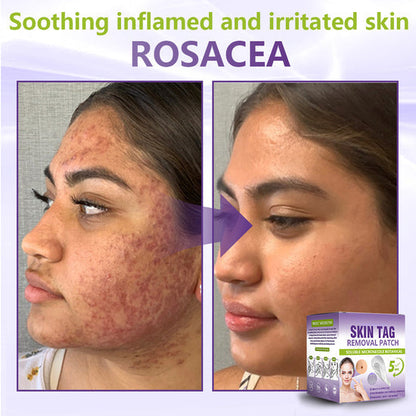 💗YOOPULSE® SOLUBLE MICRONEEDLE BOTANICAL SKIN TAG REMOVAL PATCH-ZDJ