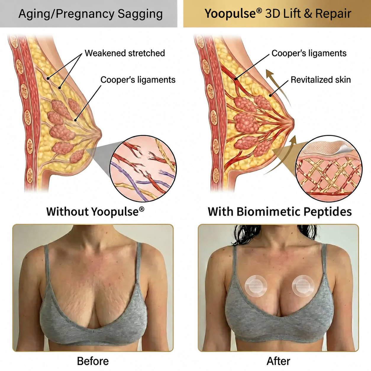 🔥Limited-time 60% sale--Yoopulse Targeted Breast Enhancement Advanced Nano-Microneedle Patches