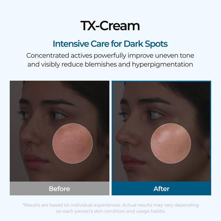 TX Cream – Dark Spot & Hyperpigmentation Corrector