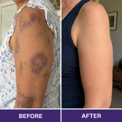 TOPSPIRE® Bruise Repair & Skin-Strengthening Cream